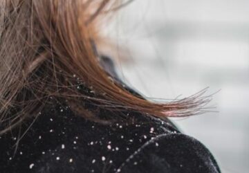 How to remove dandruff from hair