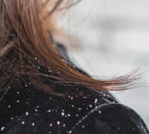 How to Remove Dandruff from Hair