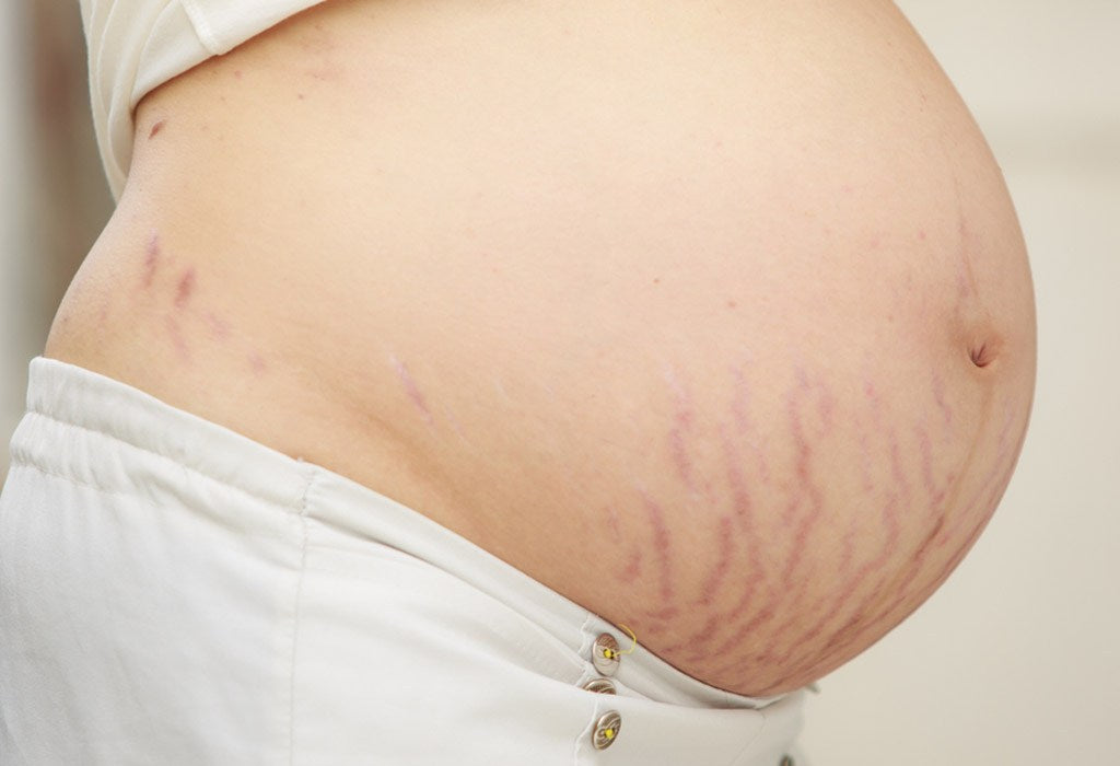 7 Tips to reduce stretch marks during pregnancy