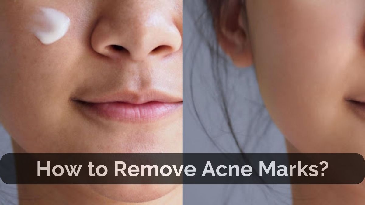 Ultimate Guide to Acne Marks Removal | Clear Skin Tips Inside