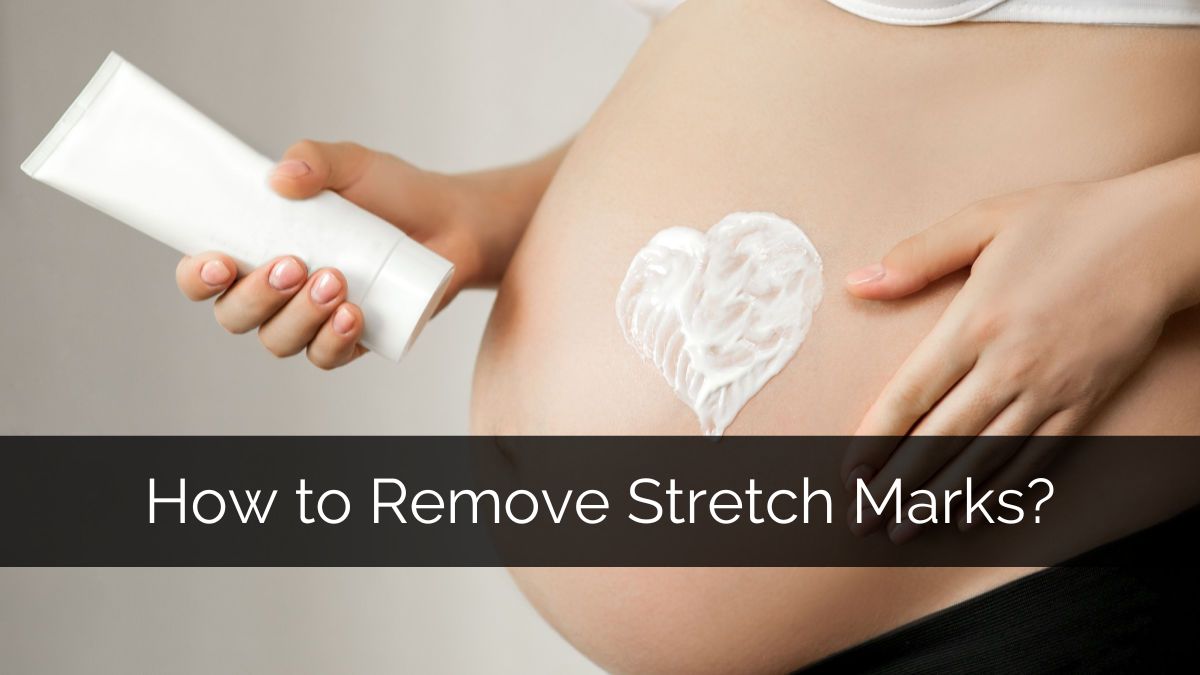 How to remove stretch marks?