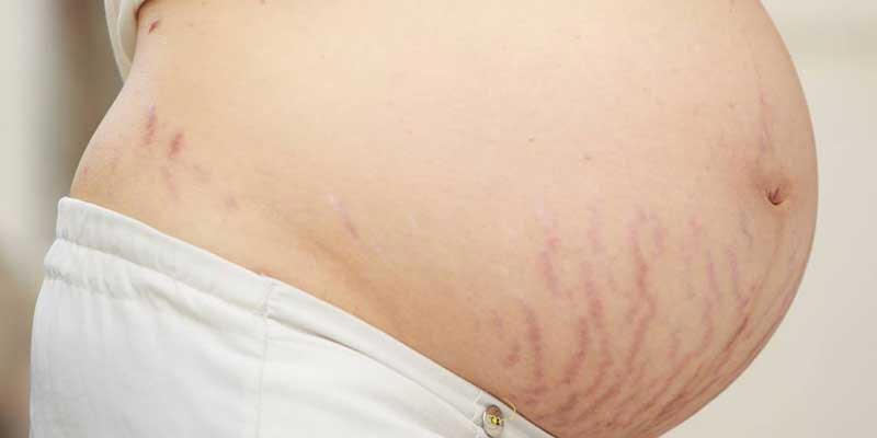 Stretch Marks During Pregnancy worrying you?