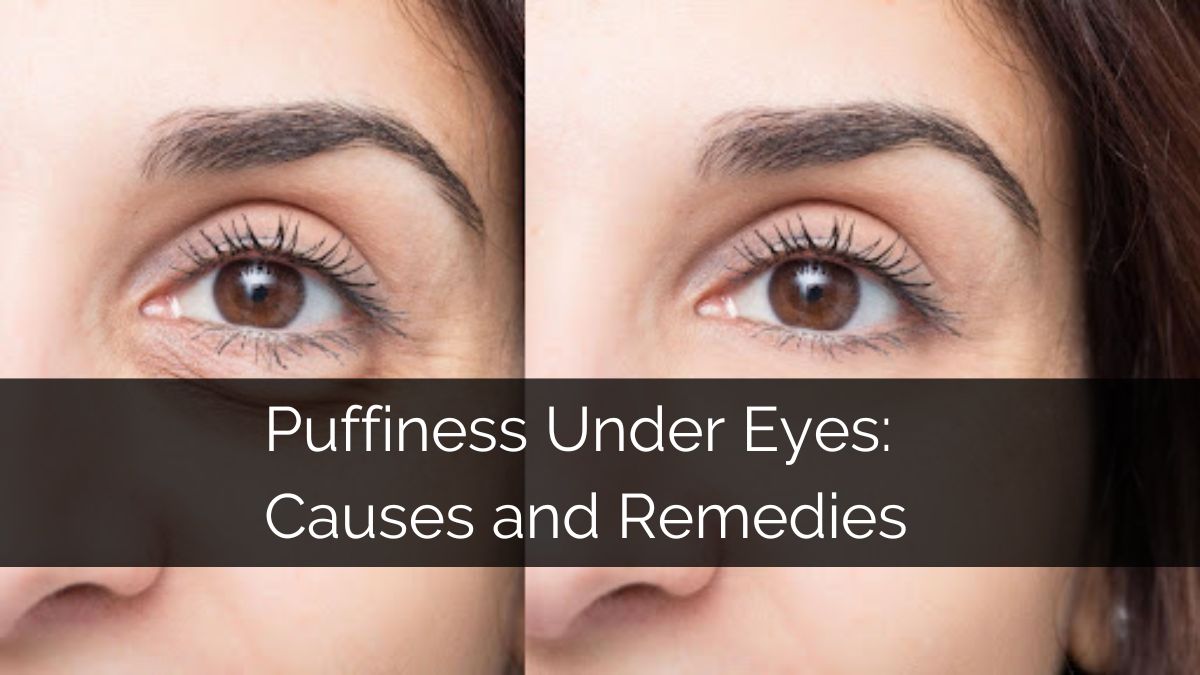 Puffiness Under Eyes - Causes & Remedies