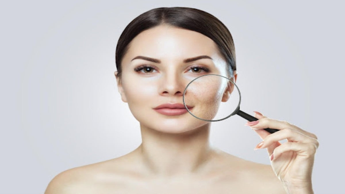 How to Remove Acne Marks from Face?
