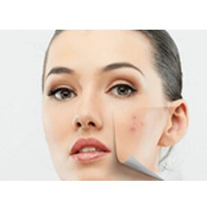 Mild, Moderate, or Severe Acne? When Home Care Works and When to See a Doctor