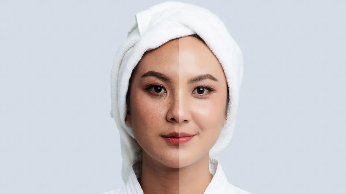 Dark patches on skin- Causes & Treatment | Mamaearth