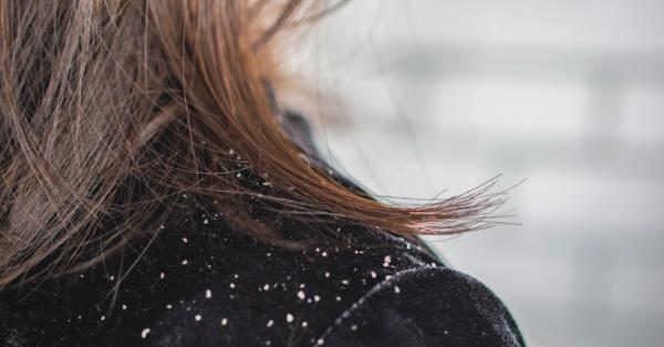 How to Remove Dandruff from Hair? | Mamaearth