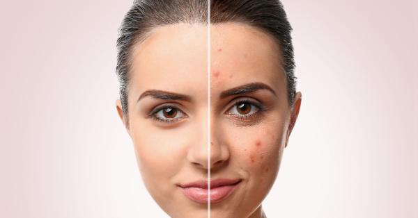 How to Clean Face Acne? | Mamaearth