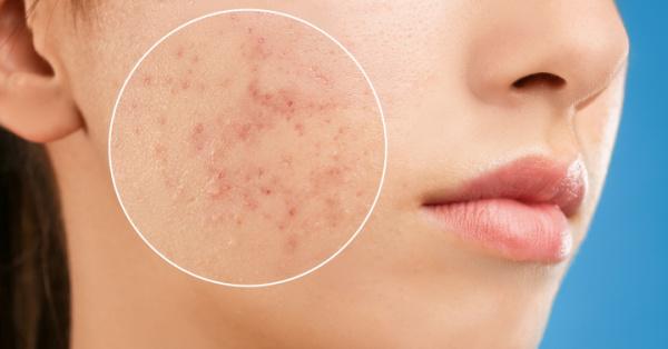 Large Pores on the Face | Tips & Tricks | Mamaearth Blog
