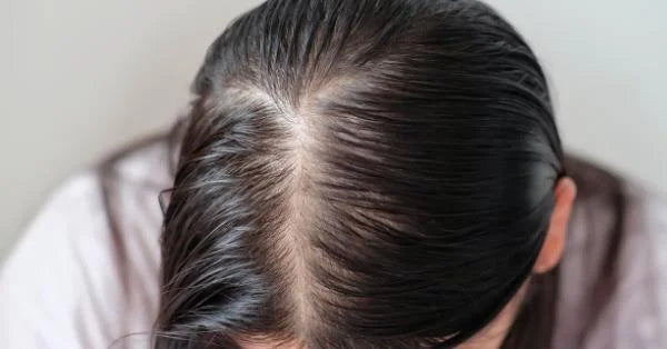 Caring for Oily Hair: A Comprehensive Guide