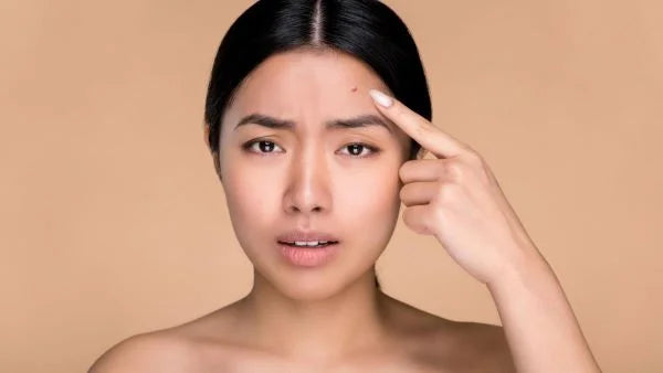 Why Pimples Occur on Face? | Mamaearth