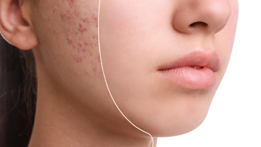 How to Remove Pimple Scars? | Mamaearth