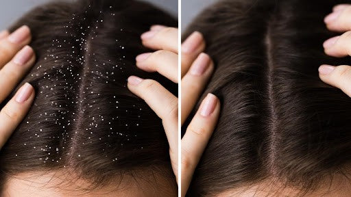 How to Get Rid of Dandruff and Hair Fall ?