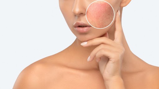 What is Pigmentation on face & How to Treat It?