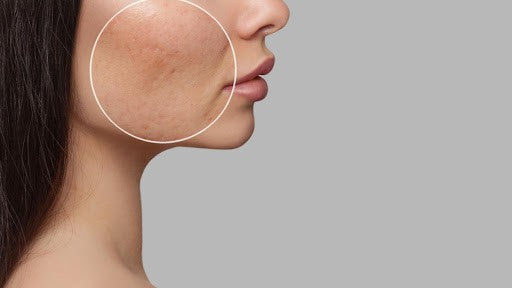 How to Remove Pigmentation from Face Permanently at Home?
