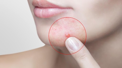 Best Way to Remove Pimple Marks Fast and Easily