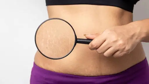 What are Stretch Marks? | Mamaearth