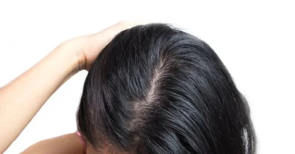 Greasy Hair Causes and How to Deal with it