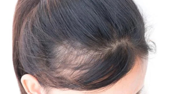 Receding Hairline : Ways to Prevent and Treatment
