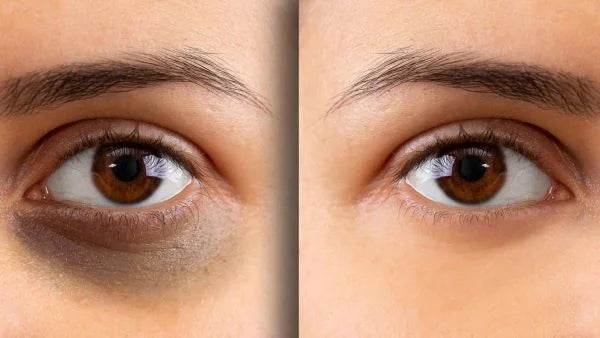 What Causes Dark Circles? | Mamaearth