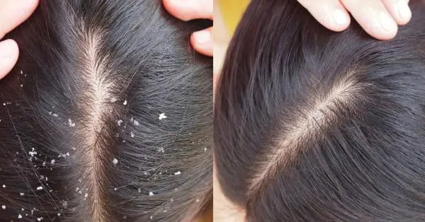Best Anti Dandruff Oil for Hair Growth