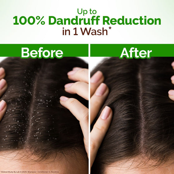 Mamaearth lemon anti dandruff shampoo for 100% dandruff reduction