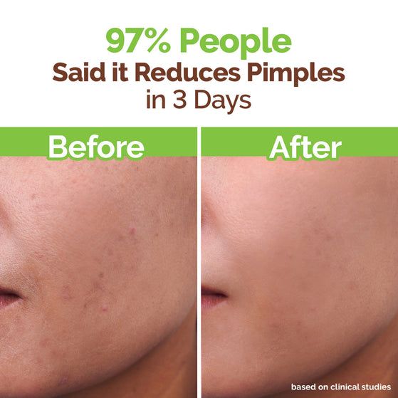 Tea Tree Pimple Control Face Wash with Tea Tree & Salicylic for Oily & Acne-Prone Skin - 150ml