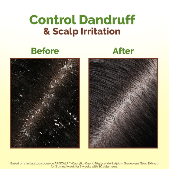 Mamaearth Lemon Anti-Dandruff Hair Oil with Lemon & Ginger for Dandruff & Itch-Free Scalp - 100 ml